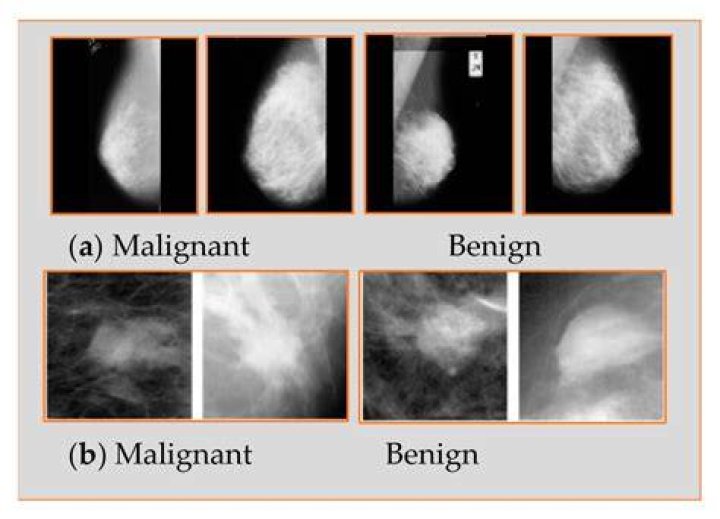 Are malignant breast tumors painful?