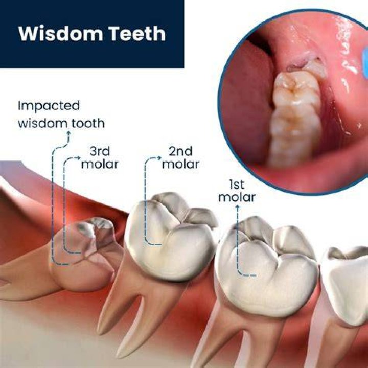 Are wisdom teeth useful?