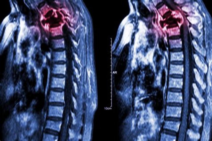 Can a bone density scan detect cancer?