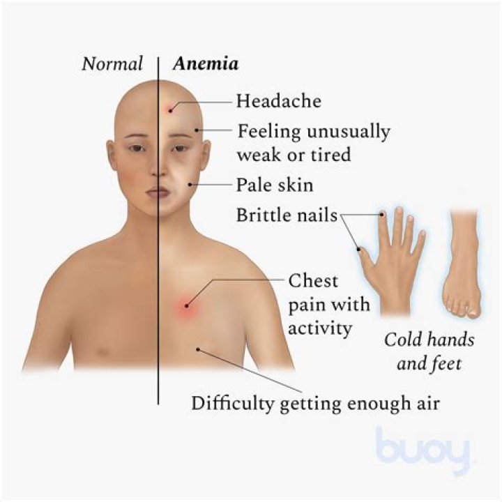 Can anaemia cause chest pain?