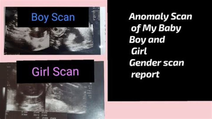 Can anomaly scan be wrong about gender?