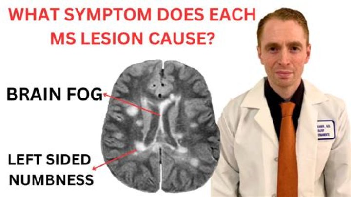 Can brain lesions make you tired?