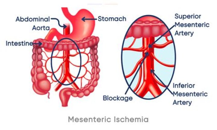 Can mesenteric ischemia be cured?