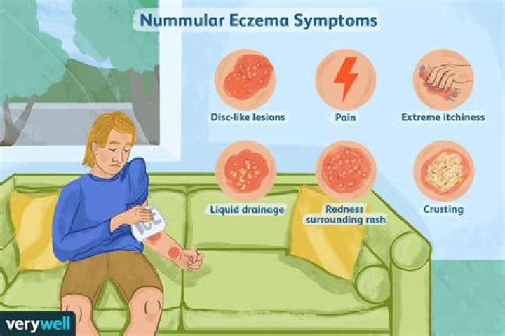 Can nummular eczema be painful?