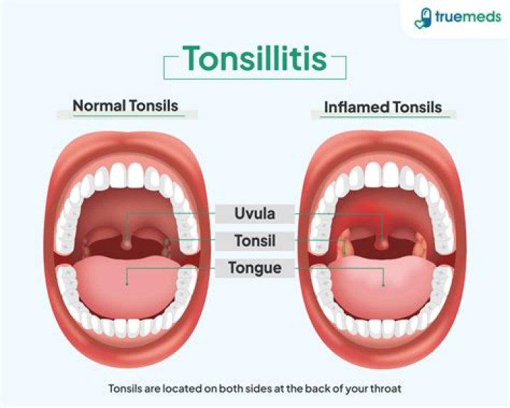 Can sleep apnea cause swollen tonsils?