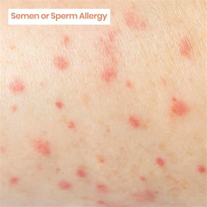 Can you be allergic to sperm?