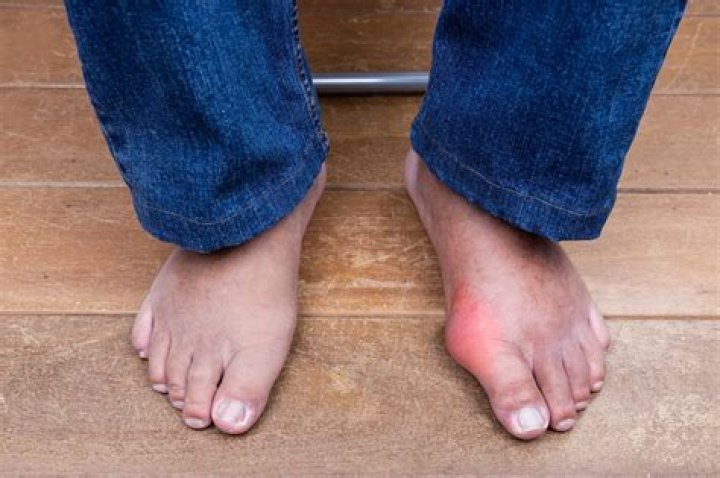 Can you die from gout?