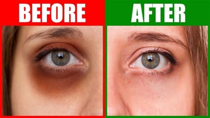 Do dark circles go away?