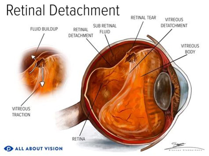Do detached retinas hurt?