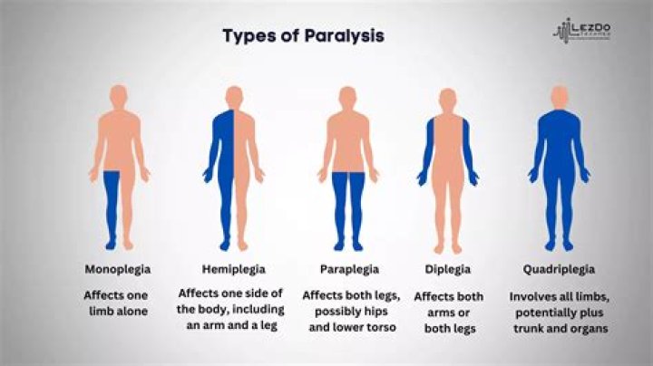 Do paralyzed limbs have feeling?