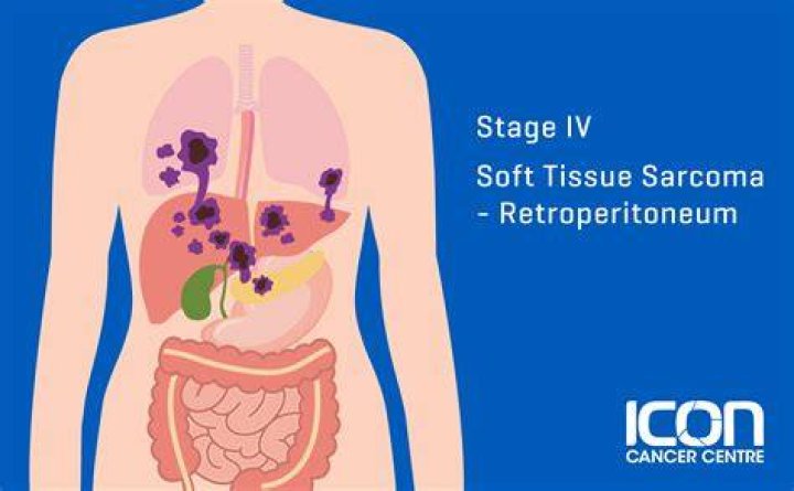 Do soft tissue sarcomas spread?