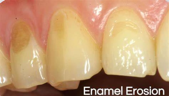 Do whitestrips damage enamel?