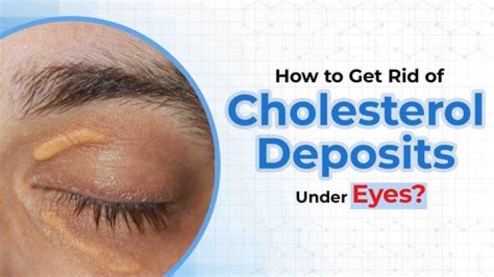 Do xanthelasma indicate raised cholesterol?