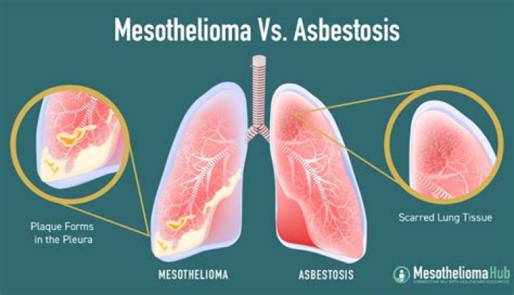 Does asbestosis turn into mesothelioma?