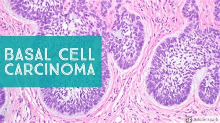 Does basal cell carcinoma bleed?