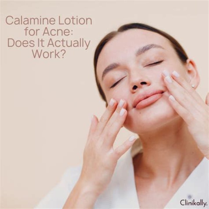Does calamine lotion help acne?