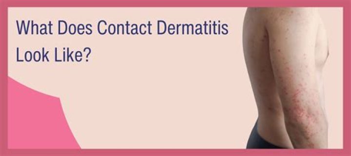 Does contact dermatitis spread?