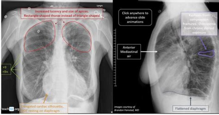 Does copd show up on xray?