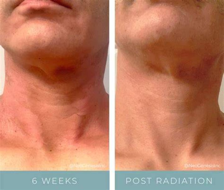 Does discoloration from radiation go away?