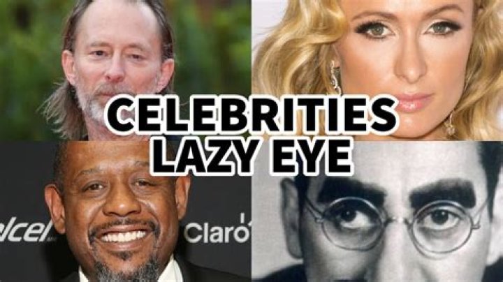 Does everyone have a slightly lazy eye?