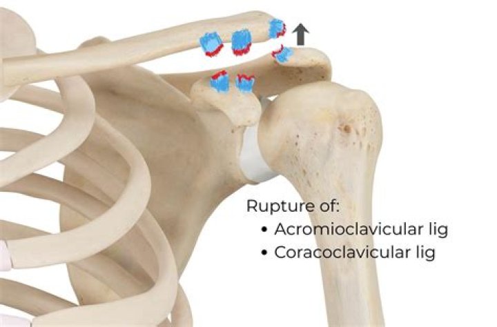 Does the acromioclavicular joint have a disc?