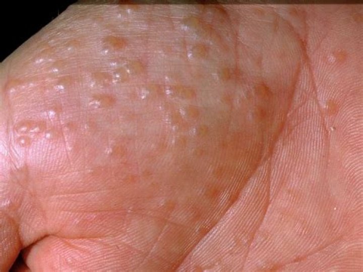 How common is pompholyx?