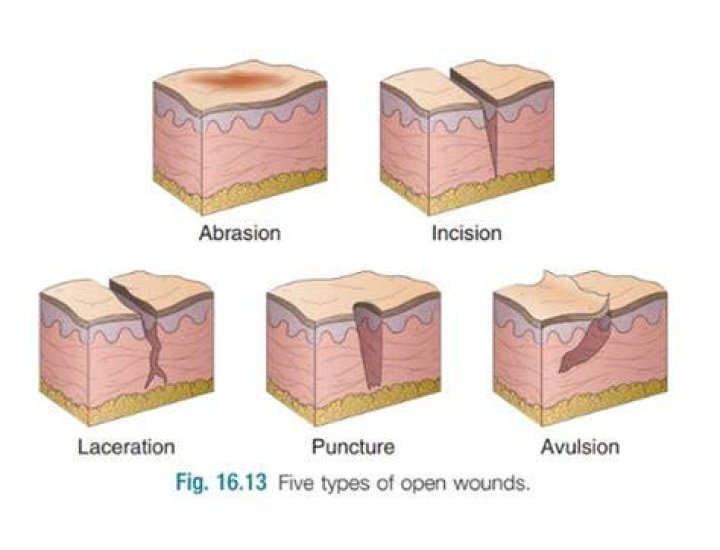 How do you treat avulsions?
