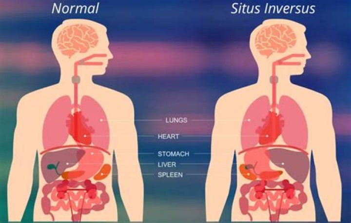 How does situs inversus occur?