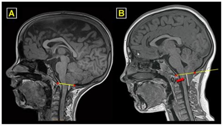 How does syringomyelia happen?