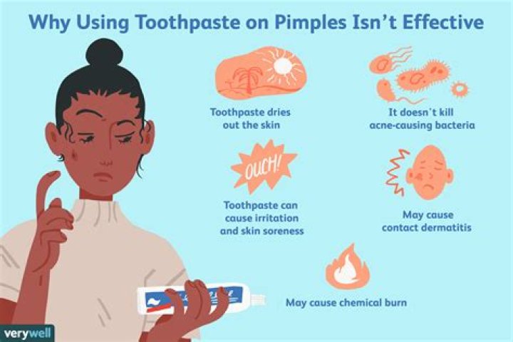 How does toothpaste get rid of pimples?