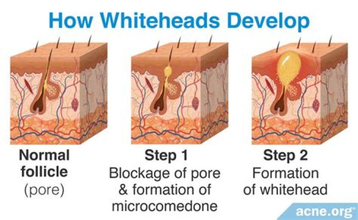 How does whiteheads form?