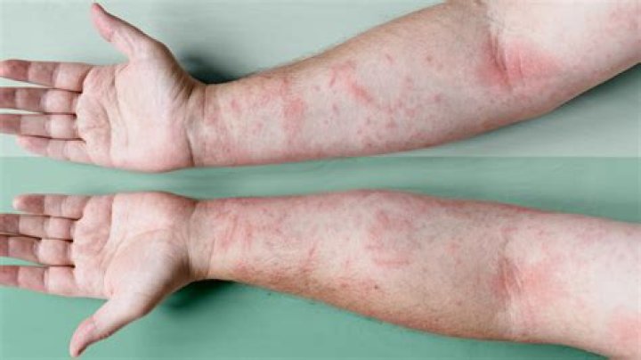 How to clear up eczema discoloration?