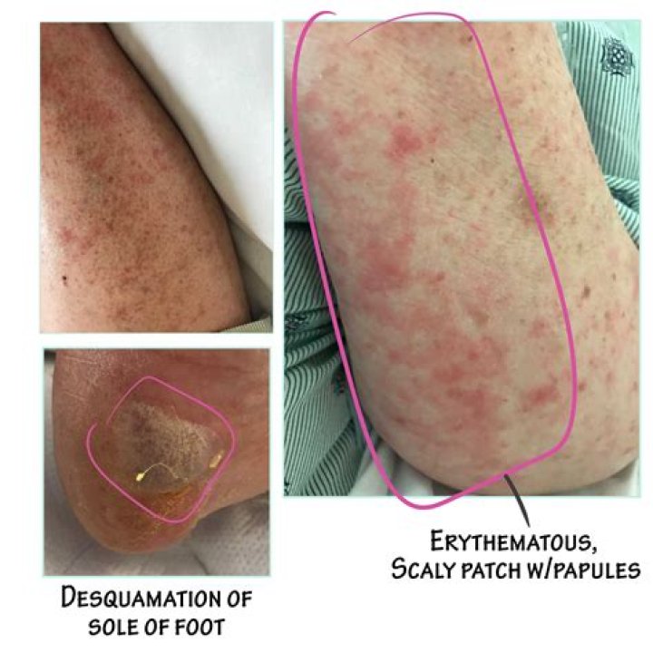 How to treat exanthematous pustulosis?