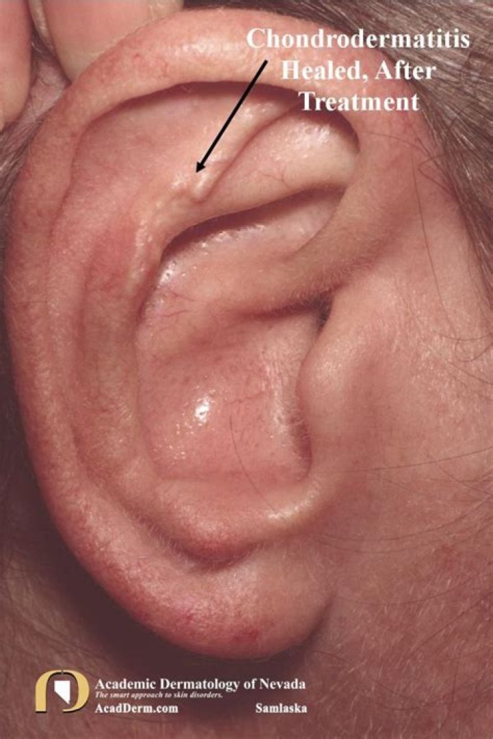 Is chondrodermatitis nodularis helicis cancerous?