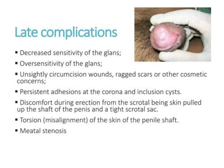 Is chordee a contraindication to circumcision?