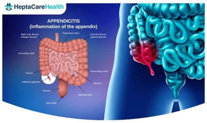 Is diarrhea normal after appendectomy?