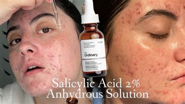 Is salicylic acid good for acne?
