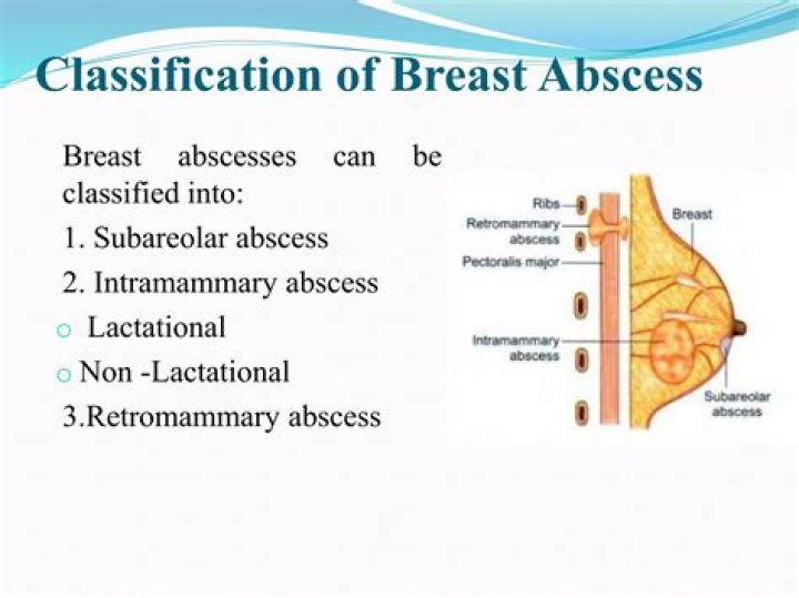 Is subareolar breast abscess cancer?