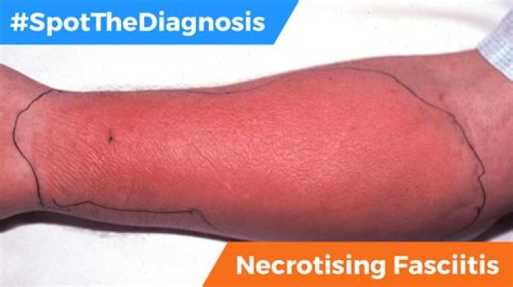 Is the causative agent of necrotizing fasciitis?