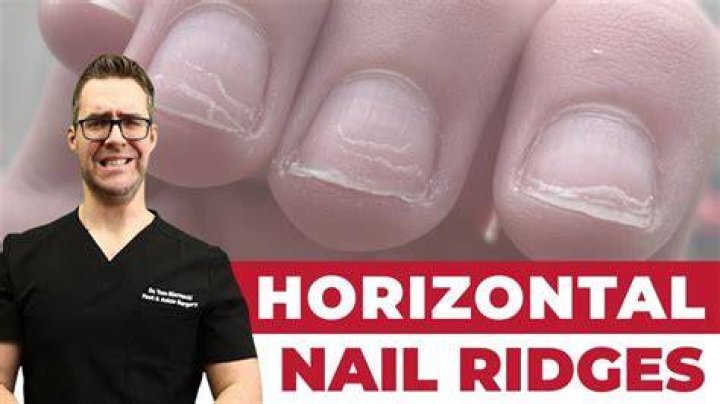 Should fingernails have ridges?