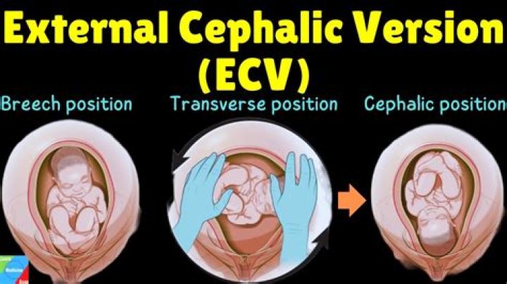 Should i have ecv or c section?
