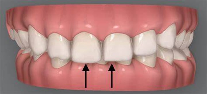 Should top teeth overlap bottom teeth?
