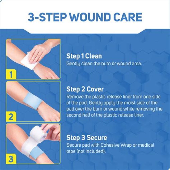 Should you bandage a burn?