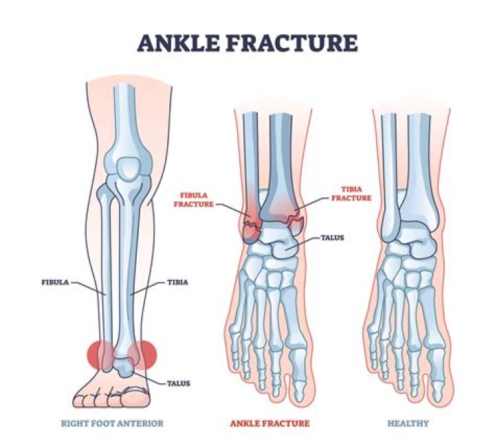Should you walk on a fractured fibula?