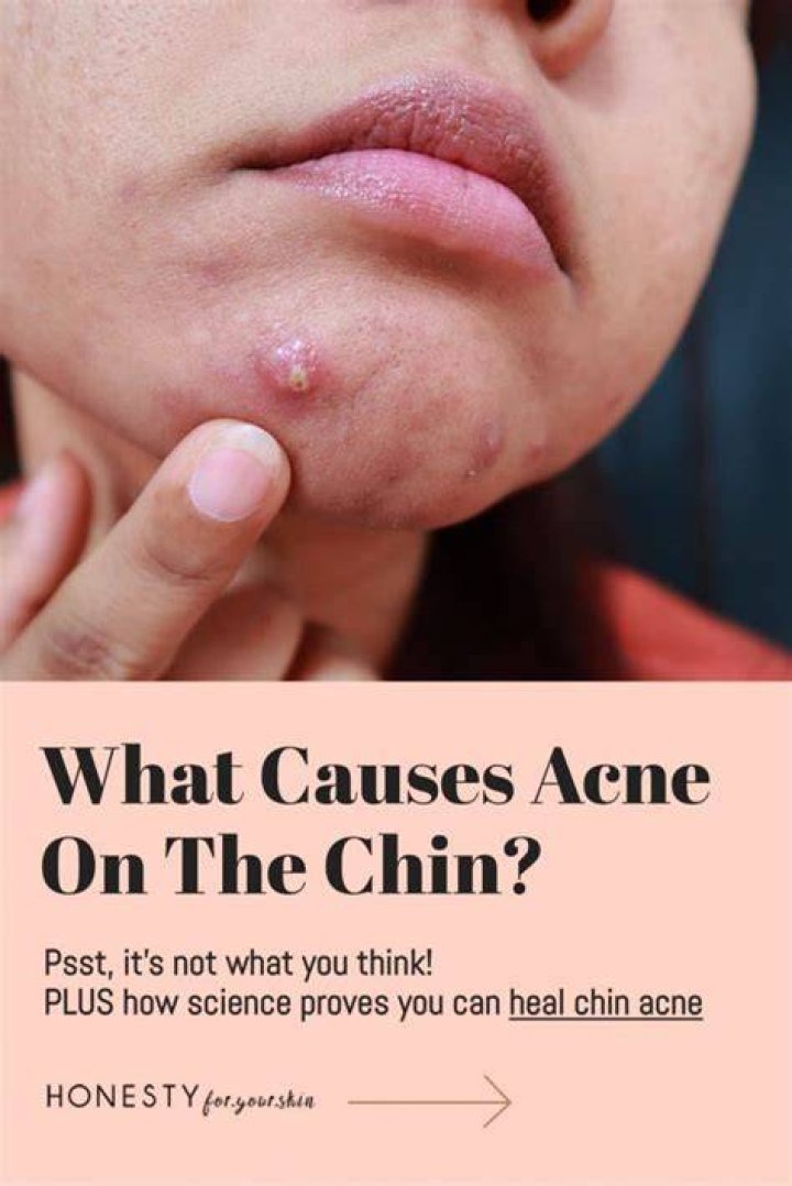 What are chin pimples from?