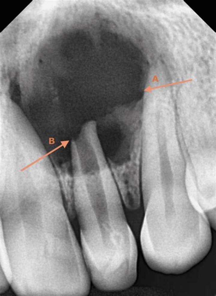 What are the fissural cyst?