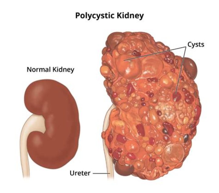 What causes blood filled cysts?