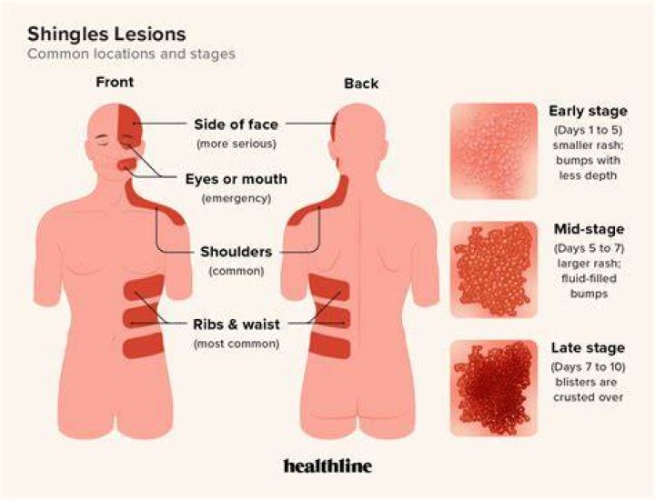 What does the early stages of shingles look like?