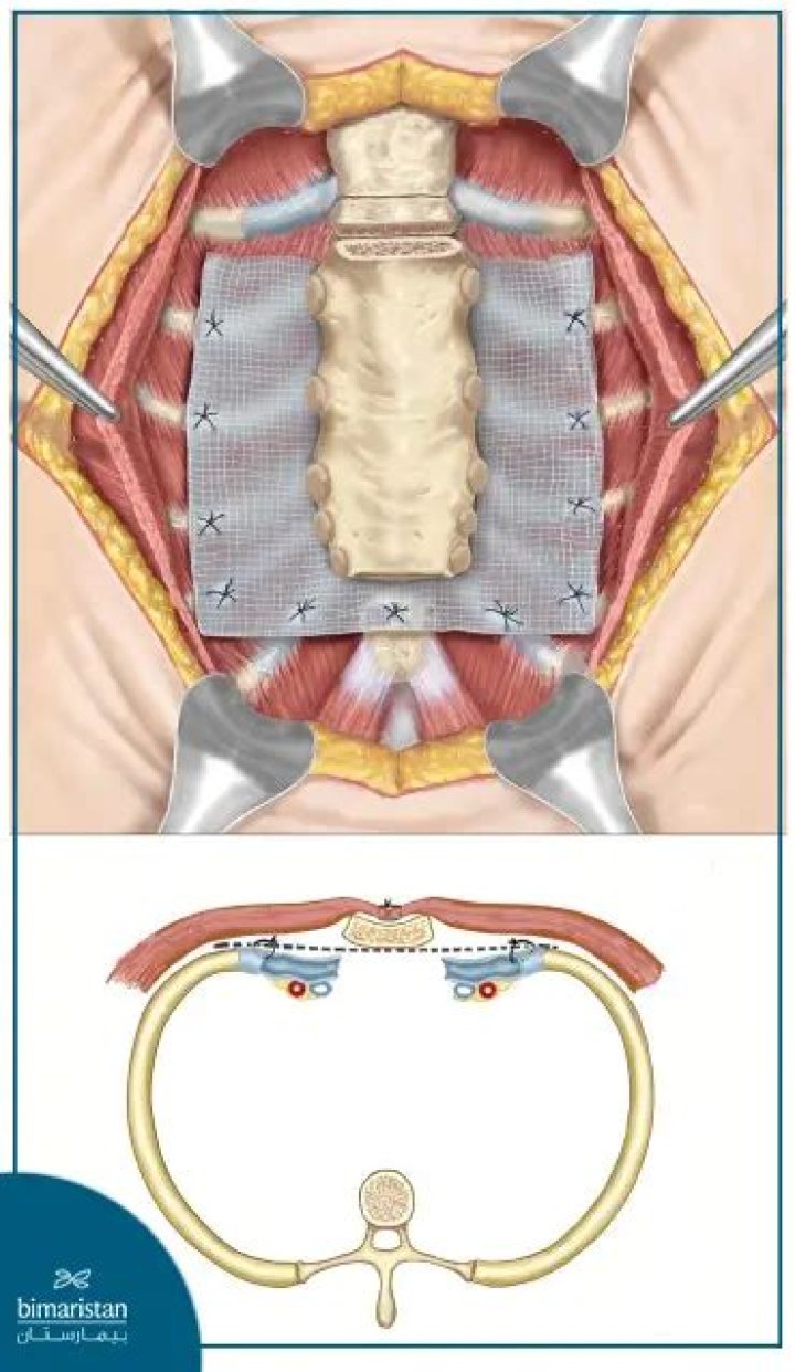 What does the word chondrotomy mean?
