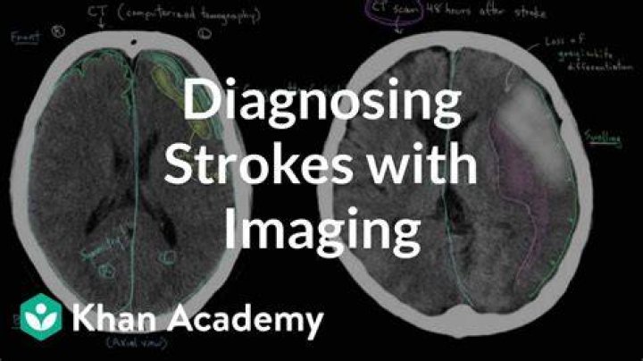 What imaging for stroke?